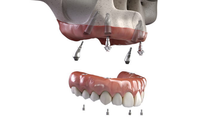 Full Arch Dental Implant Surgical Treatment: Here' how it works