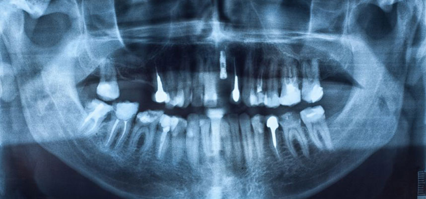 Are You Considering Dental Implants? Here Are 5 Things You Should Know Now